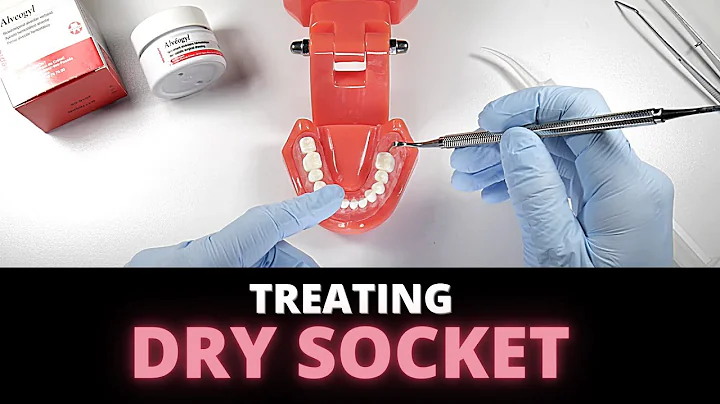 Tips For Managing Dry Socket (Alveolar Osteitis) | OnlineExodontia.com
